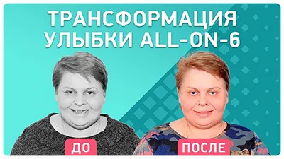 Видео - Итоги акции «Трансформация улыбки»: подробный репортаж об имплантации all-on-6