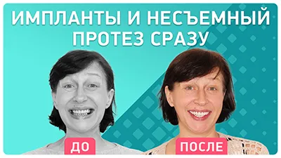 Видео - Восстановление всех зубов – комплексная имплантация за 4 дня