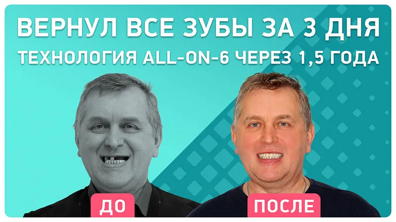 Видео - Спустя 1,5 года после имплантации all-on-6 на верхней челюсти