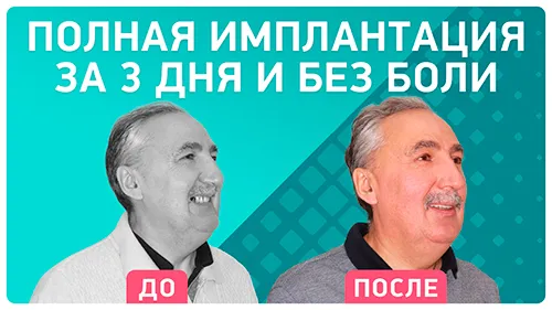 Видео - Подробно об ощущениях после комплексной имплантации