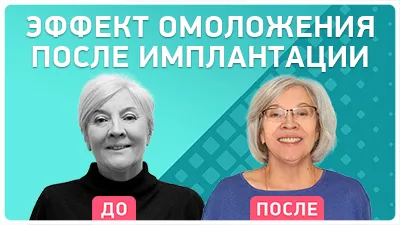 Видео - Эффект омоложения после имплантации зубов: отзыв пациентки