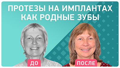 Базальная имплантация нижней челюсти Инна Андреевна