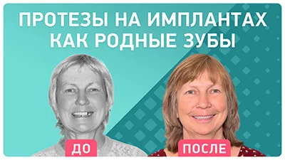 Видео - Комплексная имплантация зубов нижней челюсти. Отзыв пациента об имплантации за неделю