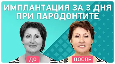 Видео - Три дня вместо 1,5 лет: как имплантация быстро возвращает к жизни