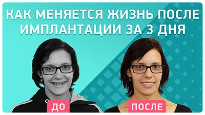 Видео - Обновленная улыбка за 3 дня! Отзыв пациентки после имплантации всех зубов