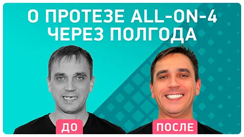 Видео - Протезирование all-on-4® Nobel Biocare при пародонтите: отзыв через 6 месяцев