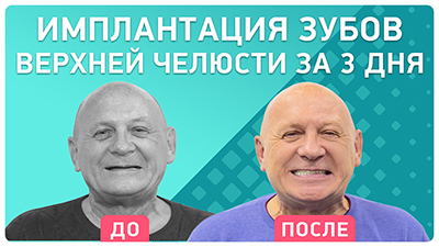 Базальная имплантация верхней челюсти Игорь Борисович
