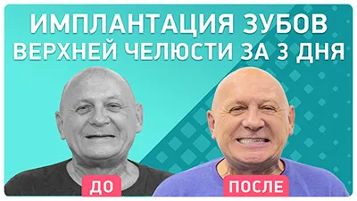 Видео - Имплантация верхней челюсти и съемный протез на нижней. Отзыв пациента об имплантации за 3 дня