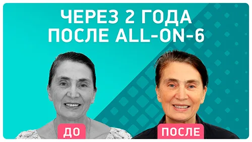 Видео - Имплантация all-on-6® спустя 2 года: из первых уст пациентки Smile-at-Once