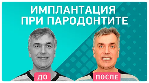 Видео - «Я полностью избавился от пародонтита» – отзыв через год после имплантации