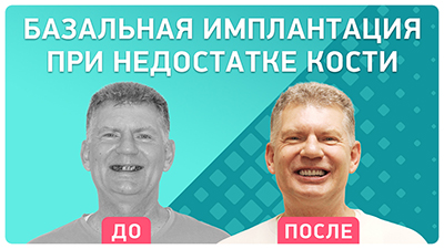 Комплексное восстановление зубов Андрею Геннадиевичу