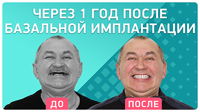 Через год после базальной имплантации Виктора Николаевича