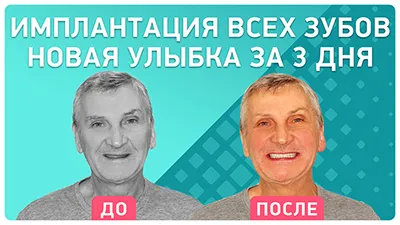 Видео - Пациент советует: решайтесь на имплантацию! Отзыв о восстановлении всех зубов