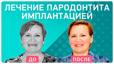 Видео - Как отказаться от съемных протезов и забыть о пародонтите: отзыв пациентки