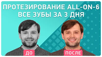 Видео - Протезирование all-on-6: за 3 дня к безупречной улыбке!