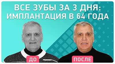 Видео - Имплантация БЕЗ возрастных ограничений: как меняется жизнь всего за 3 дня