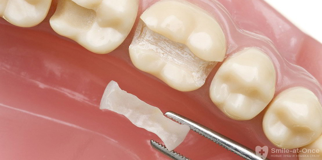 Восстановление зубов вкладками