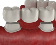 Зубные коронки и мосты при потере зубов
