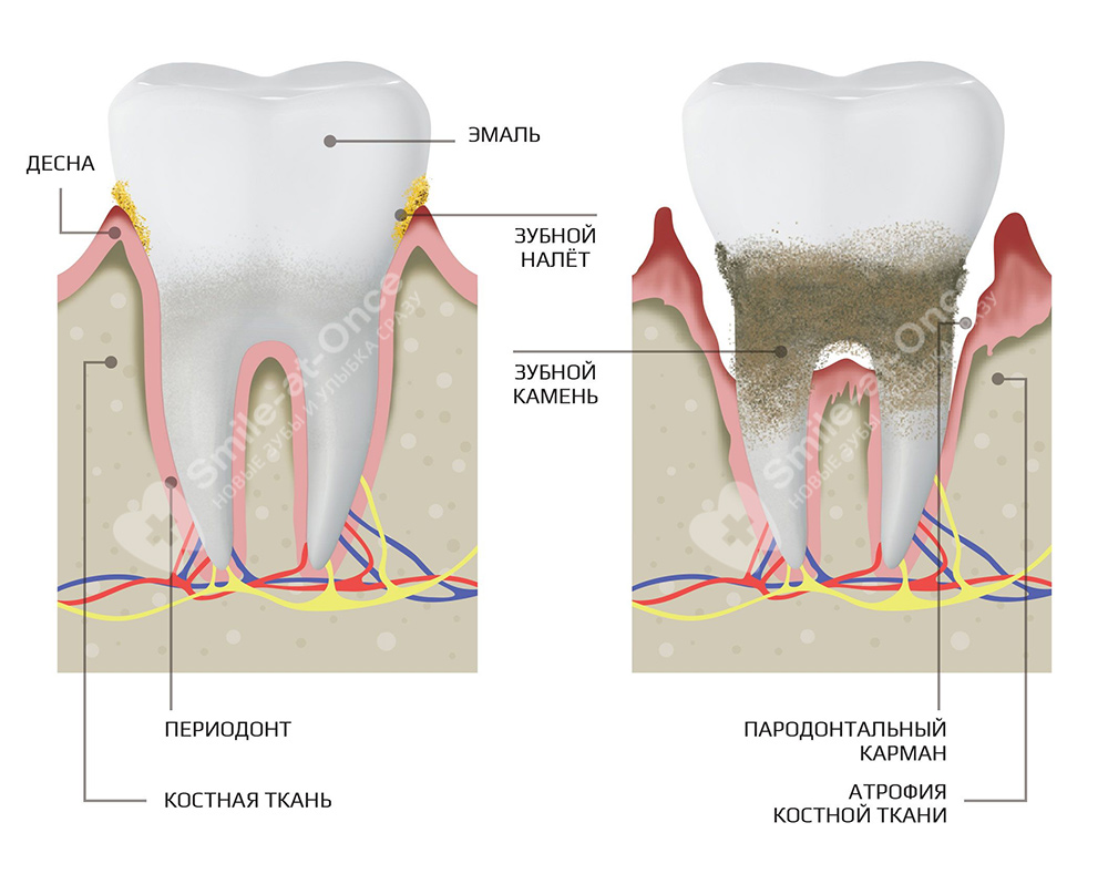 Как формируется зубной налет и камень