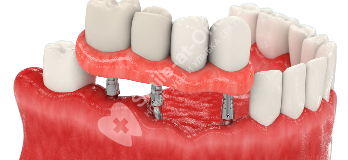 Фото зубных протезов на имплантах
