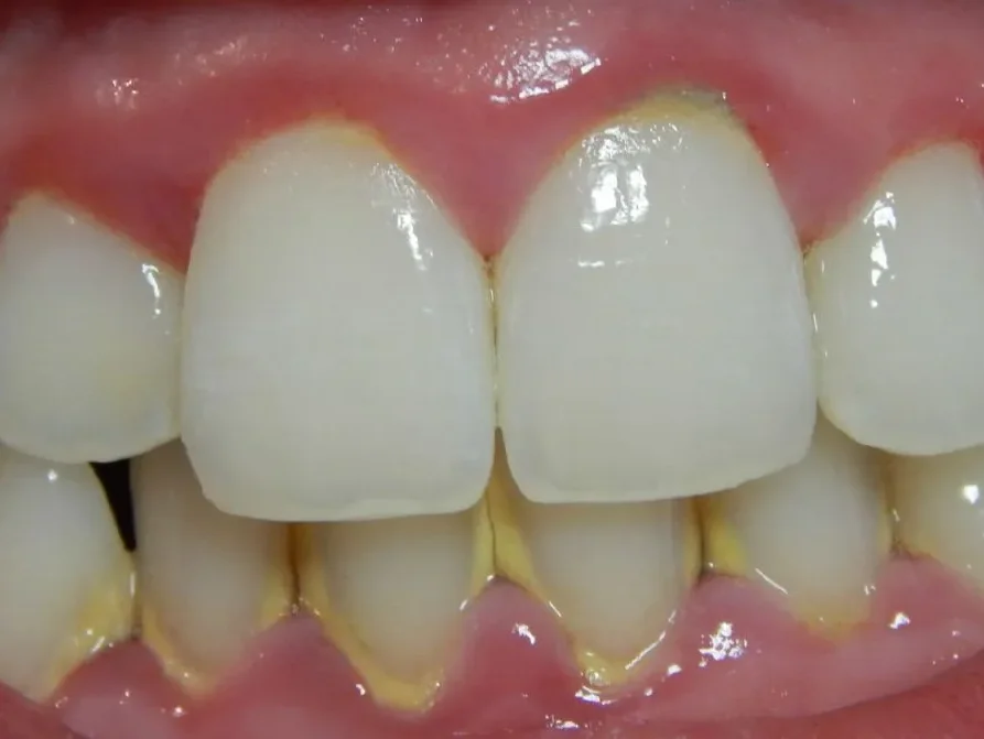Желтый налет на зубах: причины и как снять