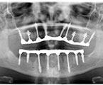 имплантация всех зубов после съемных протезов