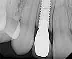 Снимок импланта переднего зуба
