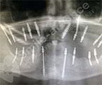 Снимок установки имплантов одновременно с удалением зубов