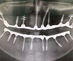 Снимок импланта переднего зуба
