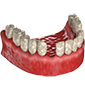 тяжёлая форма пародонтоза (выпадают зубы)