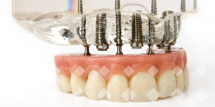 Имплантация зубов за 1-3 дня: сколько служит протез?