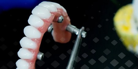 Зачем в протезе на имплантах искусственная десна?
