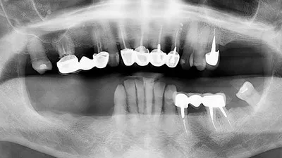 Почему панорамного снимка мало для имплантации зубов?