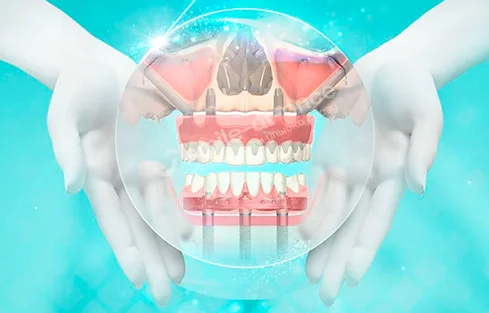 Чем может быть опасна скуловая имплантация зубов?