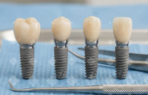 Правда ли, что зубные импланты при установке ломают кость?