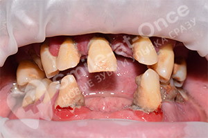 Полное восстановление зубов базальными имплантами