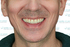 Новые зубы за 1 день ПОСЛЕ
