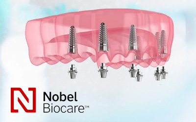 Конструкция из 6-ти имплантов Nobel Biocare – протокол All-on-6