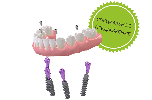 Все зубы за 3 дня на 4 имплантах Neodent