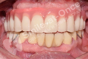 Имплантация и протезирование зубов (Однофазная)