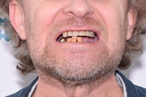 Протезирование All-on-4. Импланты Zygoma для верхней челюсти, фото до