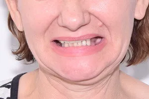 All-on-4 с двумя имплантами Zygoma для восстановления зубов на верхней челюсти, фото до