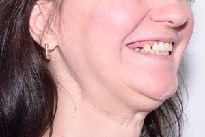 Новые зубы для пациентки из Тюмени, фото до