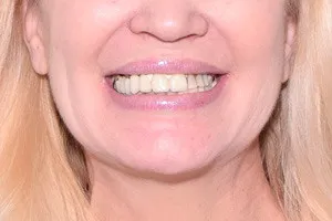 Скуловые импланты Nobel Zygoma в помощь новым зубам, фото до