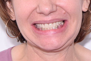 All-on-4 с двумя имплантами Zygoma для восстановления зубов на верхней челюсти, фото после