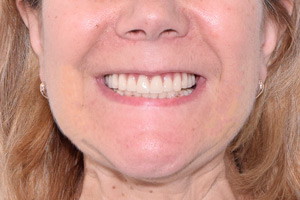 Nobel Zygoma для восстановления зубов на верхней челюсти, фото после