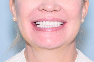 Скуловые импланты Nobel Zygoma в помощь новым зубам, фото после