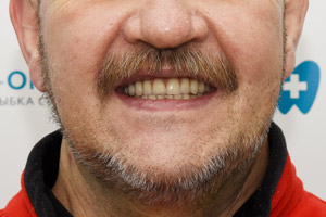 Новые зубы для верхней челюсти за 3 дня на имплантах Zygoma , фото до