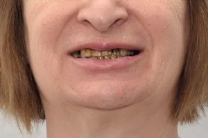 All-on-4 для новых зубов. Nobel Zygoma для верхней челюсти, фото до