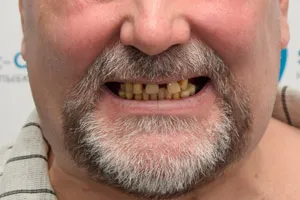 Комплексаня имплантация зубов с имплантами Zygoma, фото до
